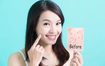 Skincare untuk kulit berjerawat